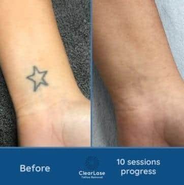 ClearLase Tattoo Removal has gone viral on TikTok.
