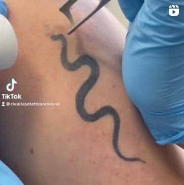 ClearLase Tattoo Removal has gone viral on TikTok.