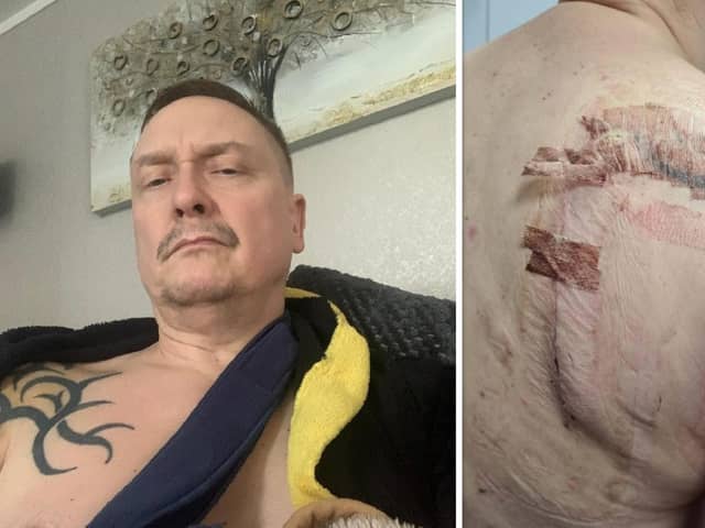 Darren believes he was hit by a vehicle while out on his bicycle, which left with multiple serious injuries including a shattered shoulder blade.