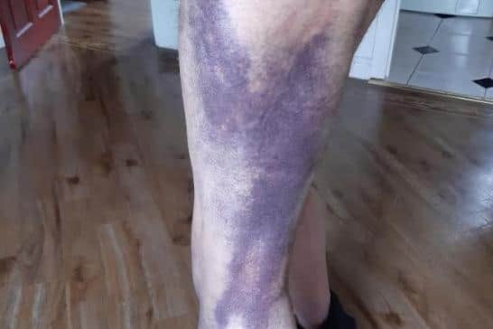 Pictured is some of the horrific bruising suffered by assault victim Brian Johnson to his leg after he was attacked by a neighbour armed with a baseball bat.