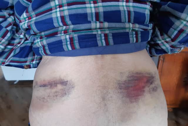 Pictured are Sheffield man Brian Johnson's injuries to his back after he was struck by a violent neighbour armed with a baseball bat.