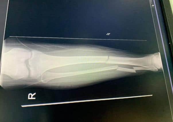 An X ray of Victim Connor Hedges leg after he was run over in January