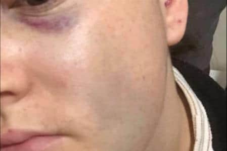 Lorna Hill's injuries after being attacked by her ex-partner, Kieron Doyle