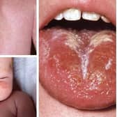 Scarlet Fever symptoms. Photo: NHS. Sheffield’s director of public health has warned that the city is seeing a rise in the contagious infection which was common in Victorian times