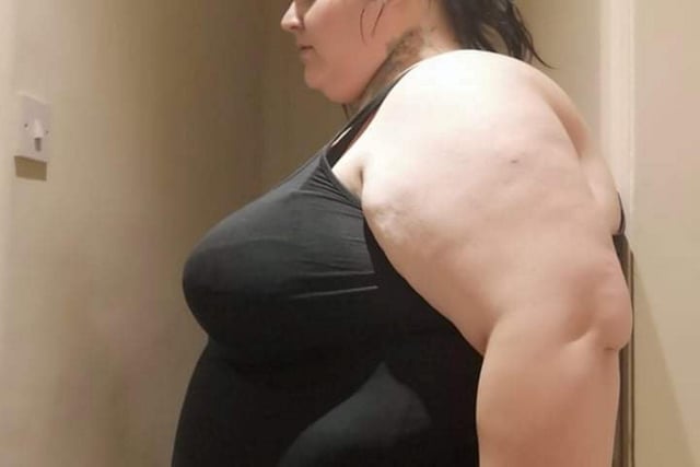 Rebecca, 30, started piling on the pounds in her teens and saw her weight rocket after falling pregnant with her child at 18 - piling on nearly 10 stone in just under two years.