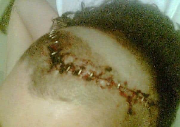 After the crash, Robert had surgery and 90 staples were put in his head