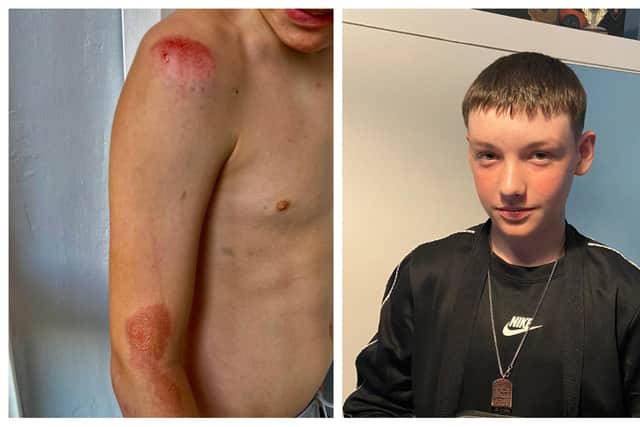 Levi Middleton-White, 13, and some of the injuries he sustained when he was hit by a driver on Birley Lane, in Sheffield, and knocked off his bike