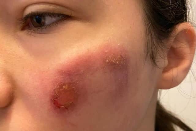 A firework exploded in a young girl's face when it was thrown at her as she walked home from school in Sheffield last week