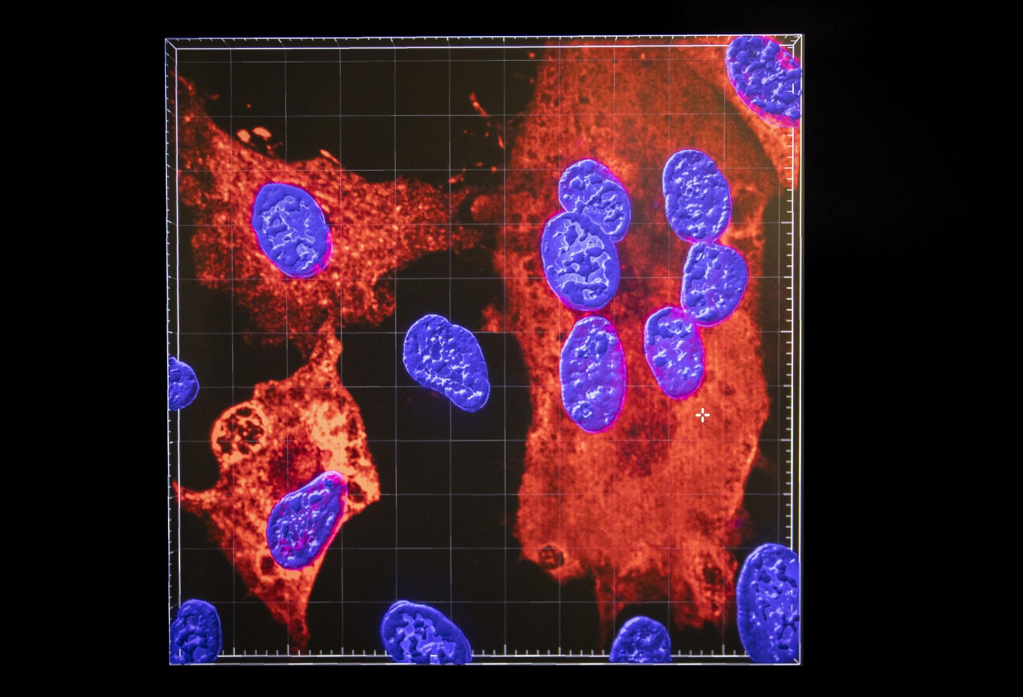 An image created with a confocal microscope shows cell nuclei (blue) being infected by SARS-CoV-2 (red areas), the virus which causes COVID-19,