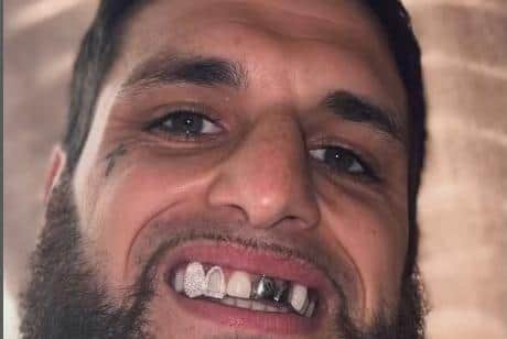 Liam Cameron and new gnashers