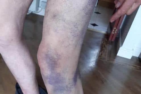 Pictured is more of the horrific bruising suffered by Sheffield assault victim Brian Johnson after he was attacked by a neighbour with a baseball bat