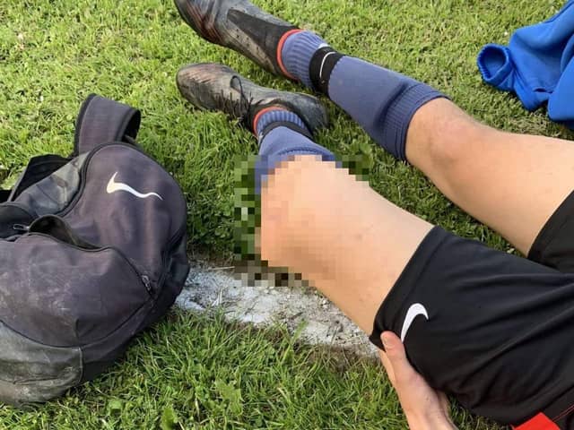 Neil's son, Lucas dislocated his knee during a football game on May 27. Picture by Neil Asquith.