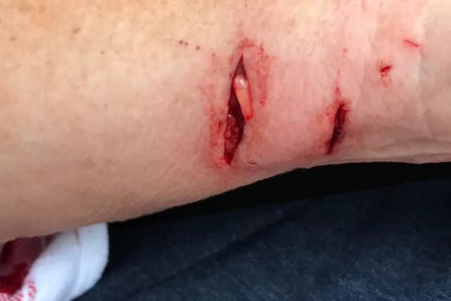 Barbara Neal's wounds after being attacked by a Bengal cat at her home in Sheffield