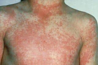 Scarlet fever can cause a rash. Photo: NHS