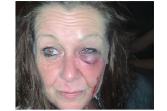 During a March 24, 2023 hearing, prosecuting barrister, Michael Masson, said an ‘altercation’ broke out as two groups left the Jack in the Pub, and the complainant, Sarah Williams, was subsequently assaulted leaving her with the injuries pictured here