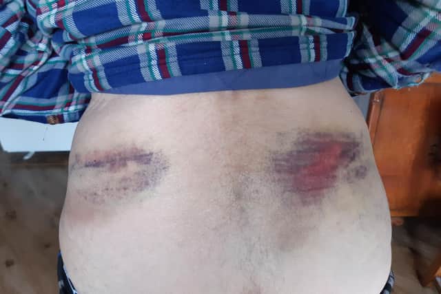 Pictured are some of Sheffield man Brian Johnson's injuries after he was attacked by a neighbour with a baseball bat.
