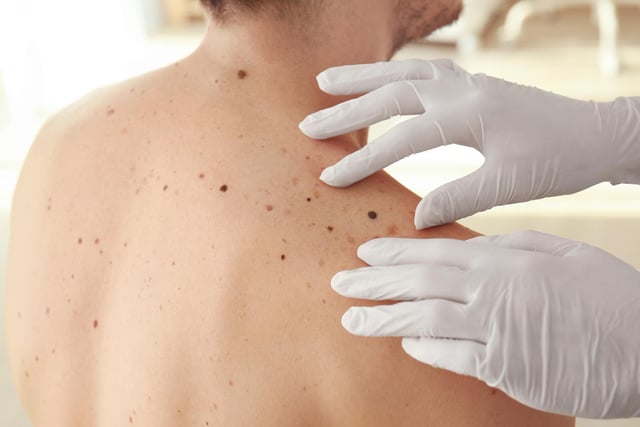 If you have a mole that changes shape or looks uneven, changes colour, starts itching, crusting or bleeding, or gets larger or more raised from the skin, it could be a sign you have malignant melanoma, which is a form of skin cancer. In most cases, a suspicious mole will be surgically removed and examined to check if it is cancerous.