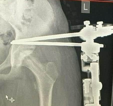 An x-ray of Mia's fixator