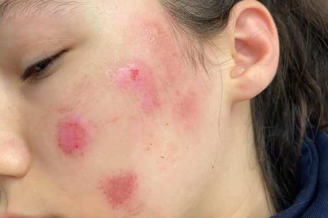 A 12-year-old girl was hit in her face with a firework in Sheffield last week