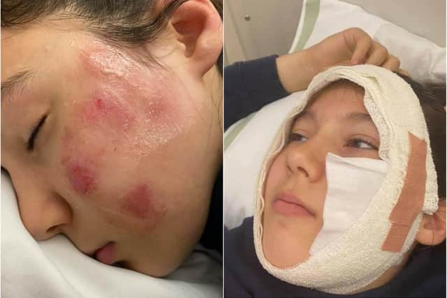 A Sheffield schoolgirl suffered facial burns when a firework was thrown at her face