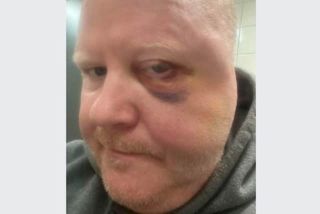 Former pool world champion Gary Swift needed surgery after he was attacked in his wheelchair on his way home from a Sheffield pub. The picture shows his injuries