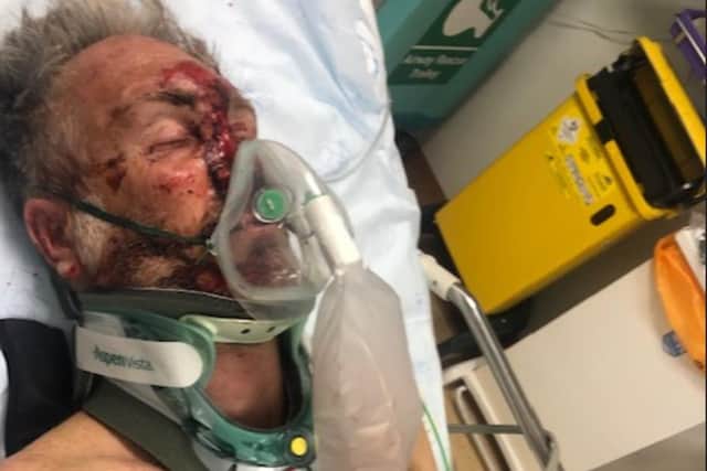 Stephen Bradbury is recovering after suffering brain injuries after being hurt in an incident while he was cycling. He is pictured after he was first injured