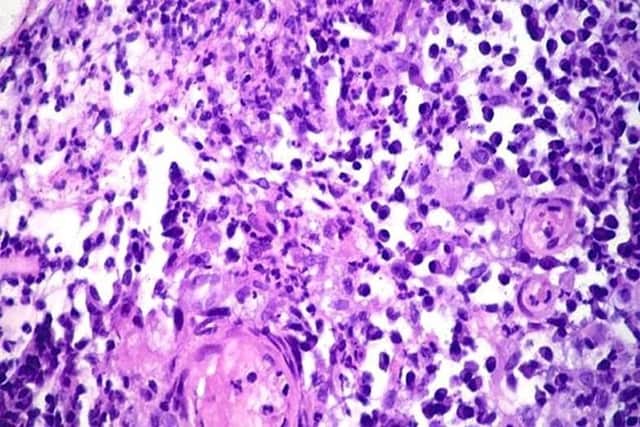 Donovanosis - Image: American Urological Association