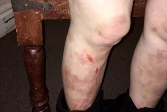 Injuries sustained by Jodie Keegans - SWNS