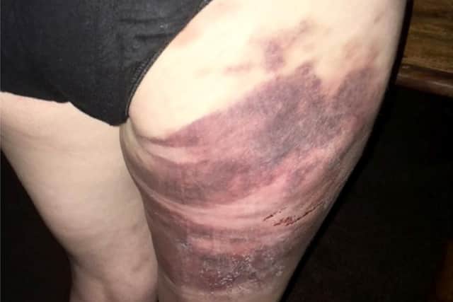 The injuries sustained by Jodie Keegans, 36, at the hands of her husband Scott Keegans, 34