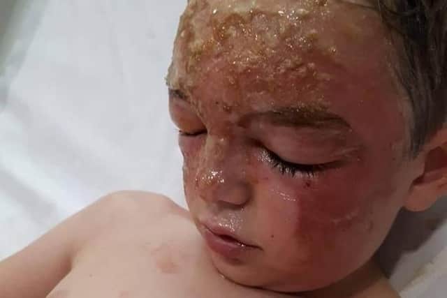 Owen Atkins, aged seven, in hospital with severe burns
