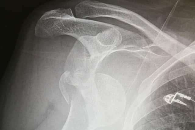 An x-ray showing the damage to Stewart Smith's shoulder after the hit-and-run collision on the Stocksbridge bypass