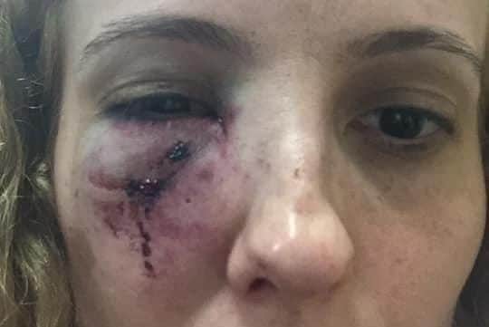Injuries to Ms Piticii's eye