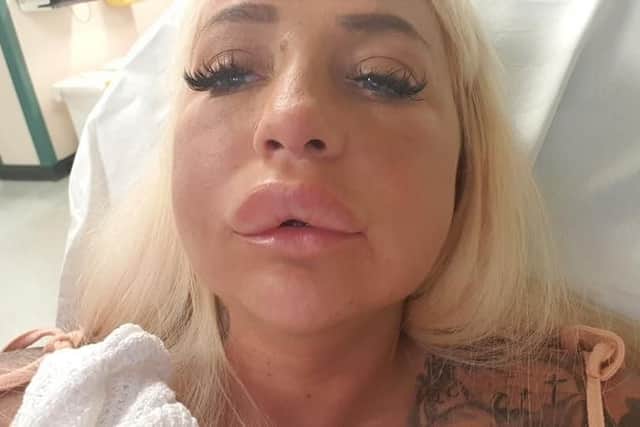 Kirsty - aka porn star Bambi Blacks - after he extreme reaction to material used to dissolve lip filler.