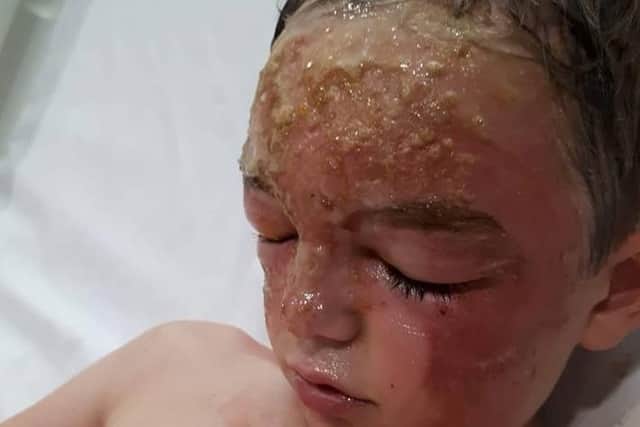 Owen Atkin, aged seven, is recovering at Sheffield Children's Hospital after being scalded by boiling water on Saturday night