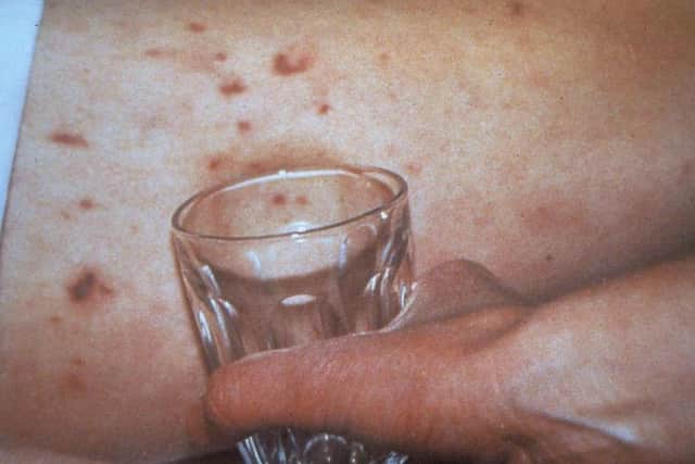 Symptoms of meningitis include a rash which doesnt fade under pressure