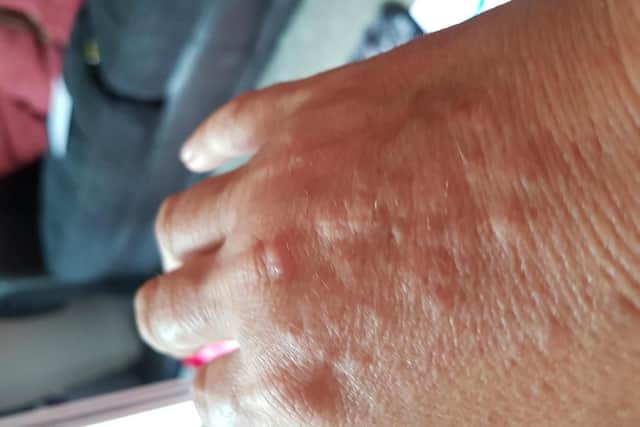 Hives on Maxine's hand after it has been exposed to water