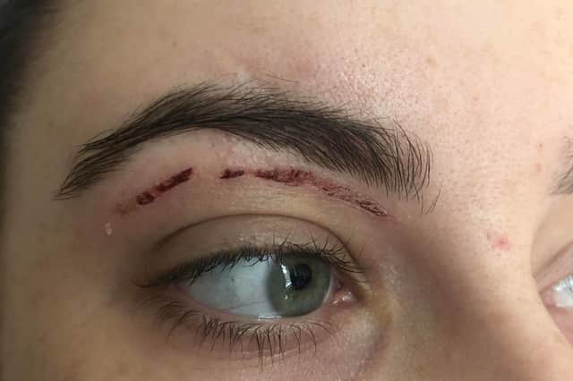 Emily had been left with a burn to her face after an eyebrow wax at Superdrug Meadowhall