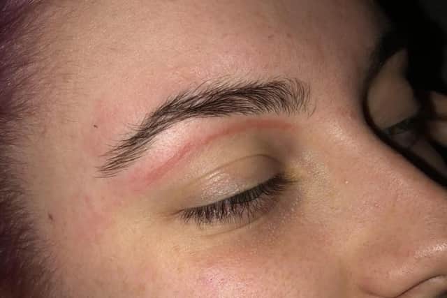 Emily had been left with a burn to her face after an eyebrow wax at Superdrug Meadowhall