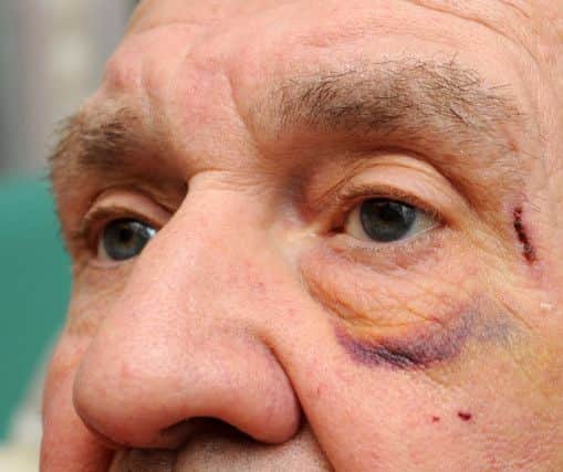Injuries that Johnny Chappell suffered after he was attacked by three men who also killed his dog. Picture: Andrew Roe