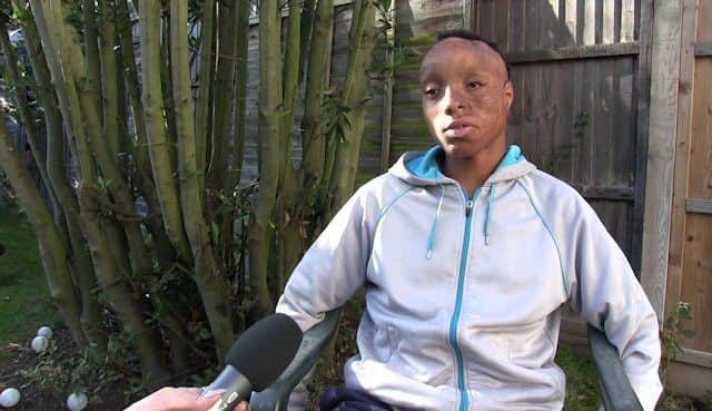 Sheffield Hallam University student Lucy Wilson, 21, has set up ScarGlobal.org, a website that tells the stories of burn survivors all over the world. Sizwe, from South Africa.