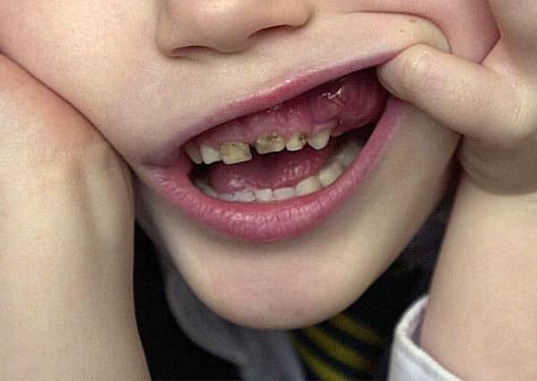 Sheffield has the highest figure for tooth decay among children