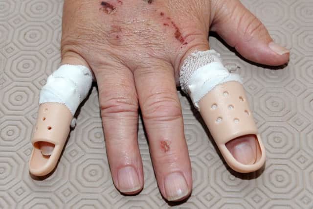 Injuries sustained by Ian Jones, who was the victim of a carjacking. Picture: Andrew Roe