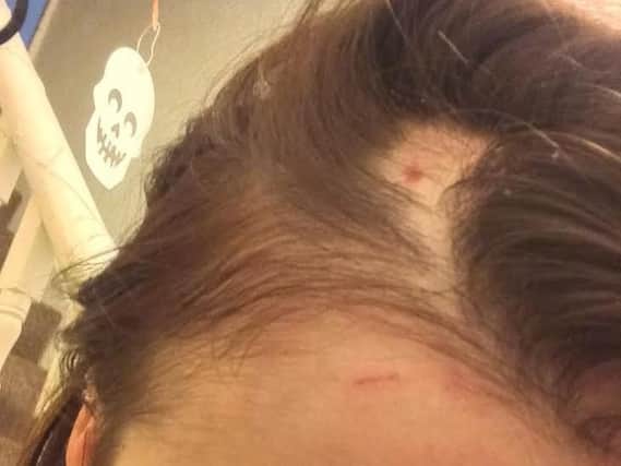 Lydia Smith, 21, had her hair ripped out during at attack in Aslan's takeaway in West Street