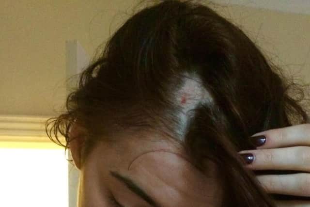 Lydia Smith, 21, had her hair ripped out during at attack in Aslan's takeaway in West Street