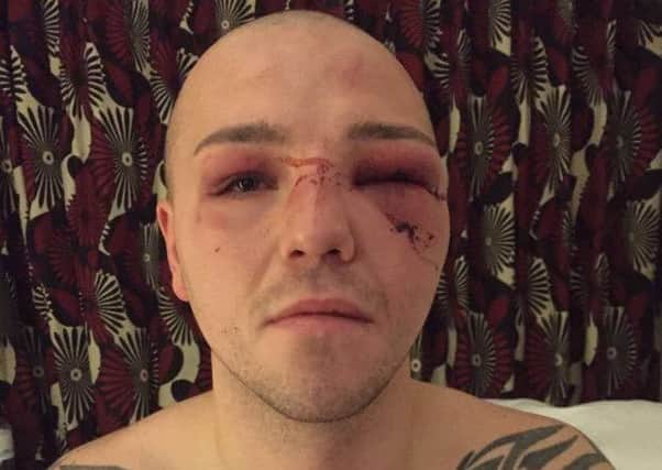 Adam Etches, bruised after John Ryder defeat