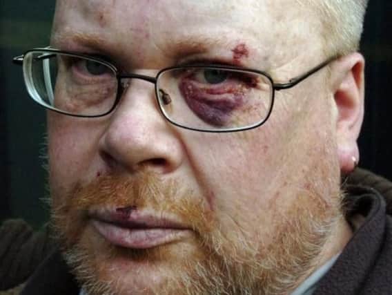 Dean Chambers pictured after an attack at his Totley home in 2012