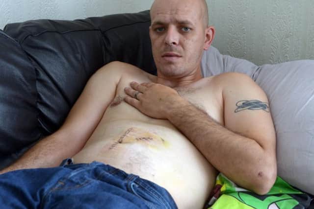 Craig had to undergo emergency surgery for the injuries he suffered to his stomach