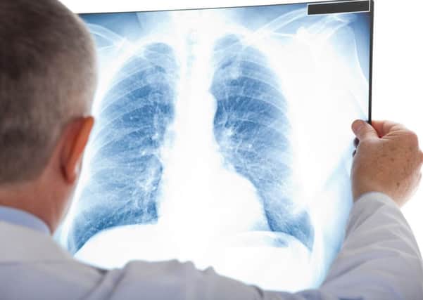 A Generic Photo of a a doctor looking at a chest xray. See PA Feature HEALTH Lung Cancer. Picture credit should read: PA Photo/thinkstockphotos. WARNING: This picture must only be used to accompany PA Feature HEALTH Lung Cancer.