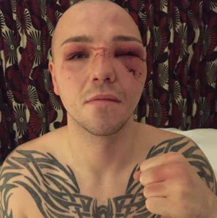 Adam Etches, bruised after John Ryder defeat