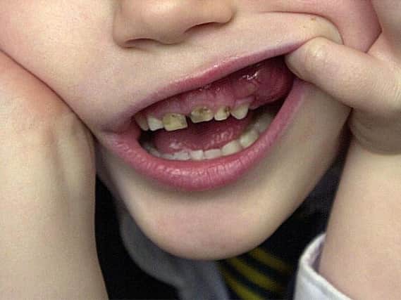 Councillors will consider an update on tooth decay in Sheffield